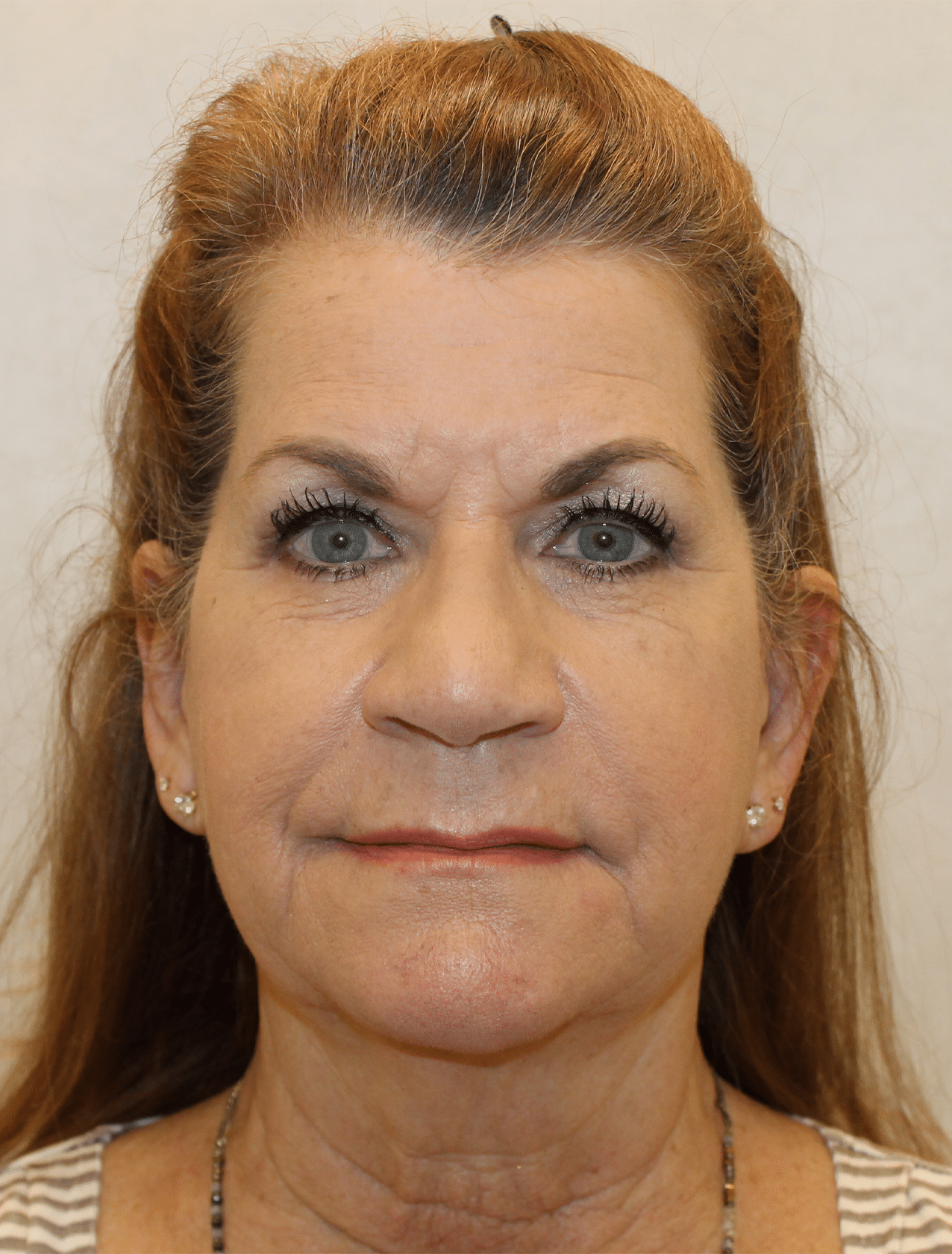 Before Image: Case 9619 – Gaines Plastic Surgery - front