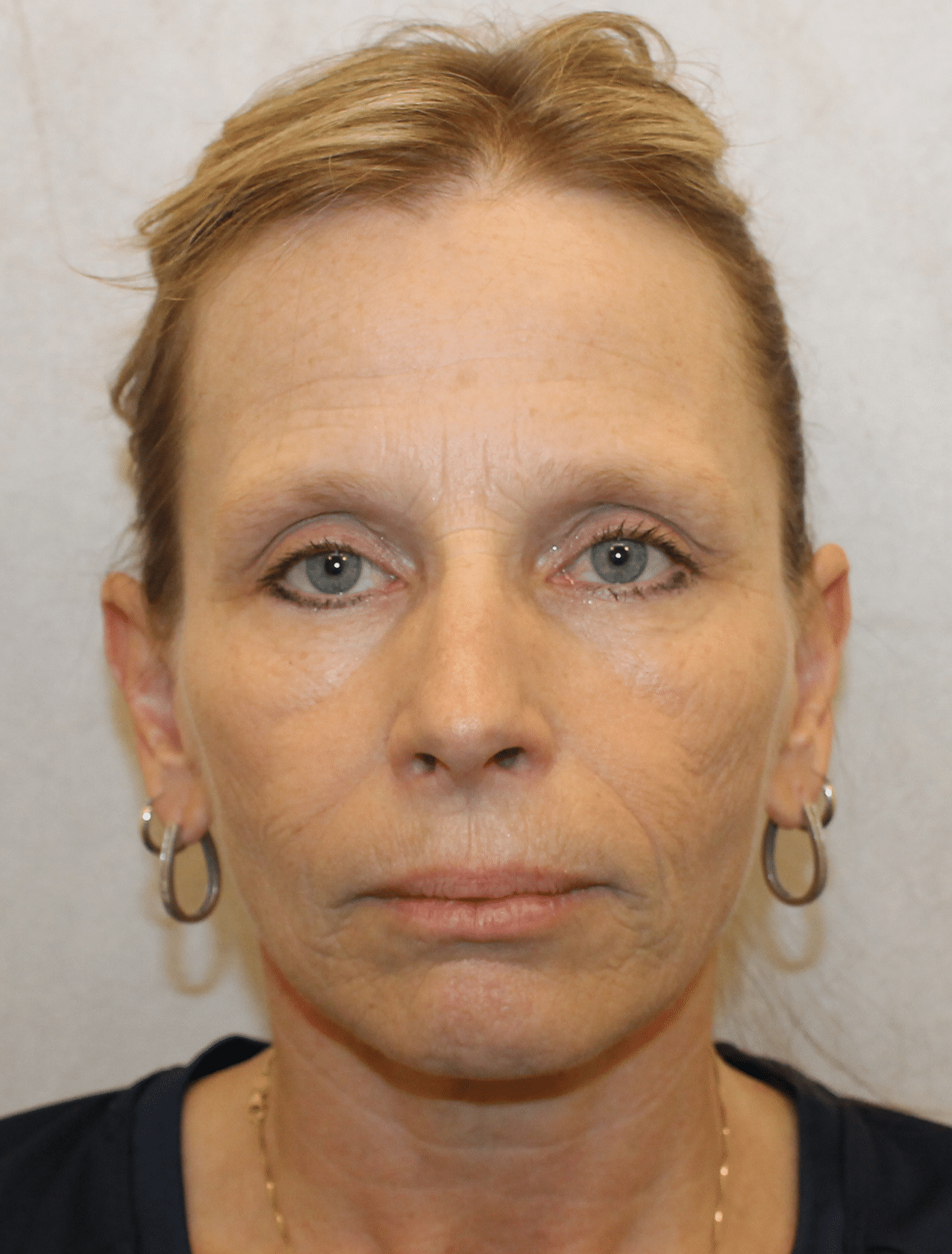 Before Image: Case 9678 – Gaines Plastic Surgery - front