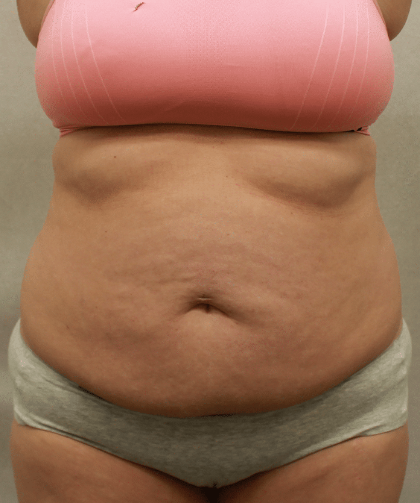 Before Image: Case 9689 – Gaines Plastic Surgery - front
