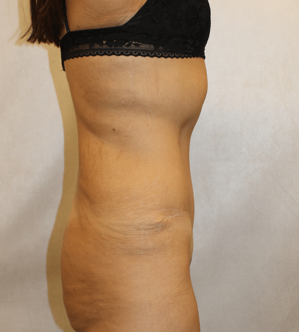 After Image: Case 9665 – Gaines Plastic Surgery - right-side