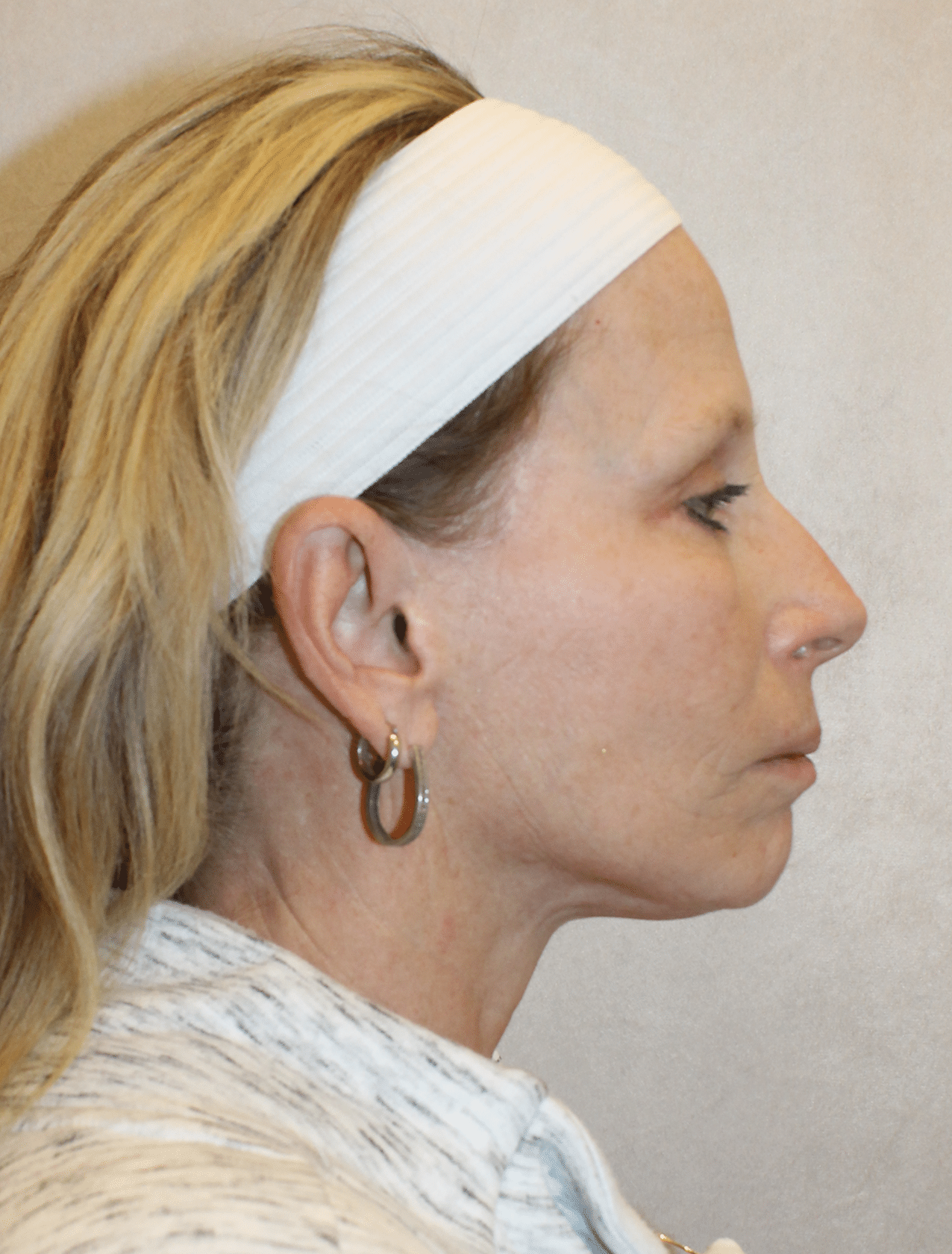 After Image: Case 9678 – Gaines Plastic Surgery - right-side