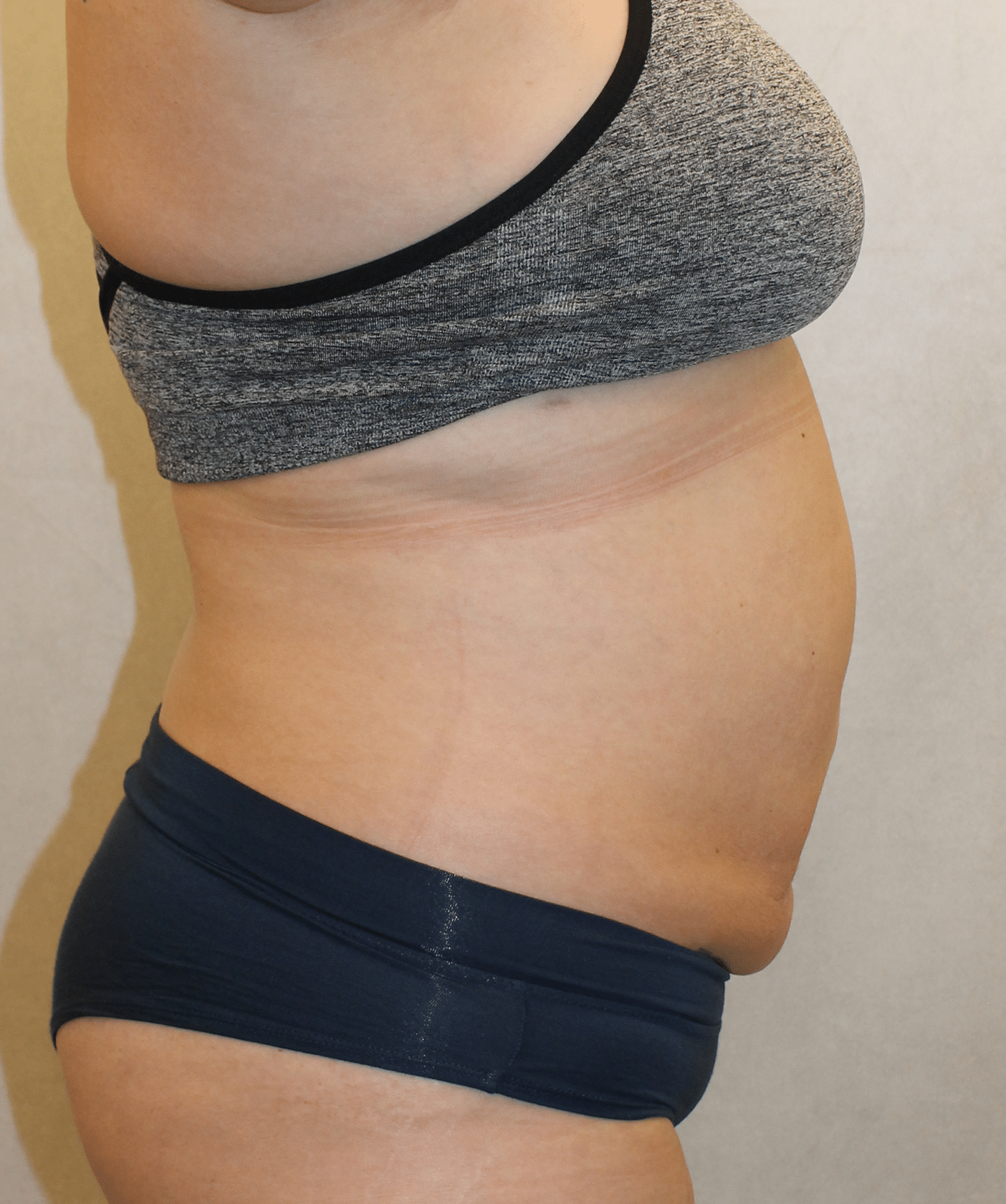 After Image: Case 9689 – Gaines Plastic Surgery - right-side