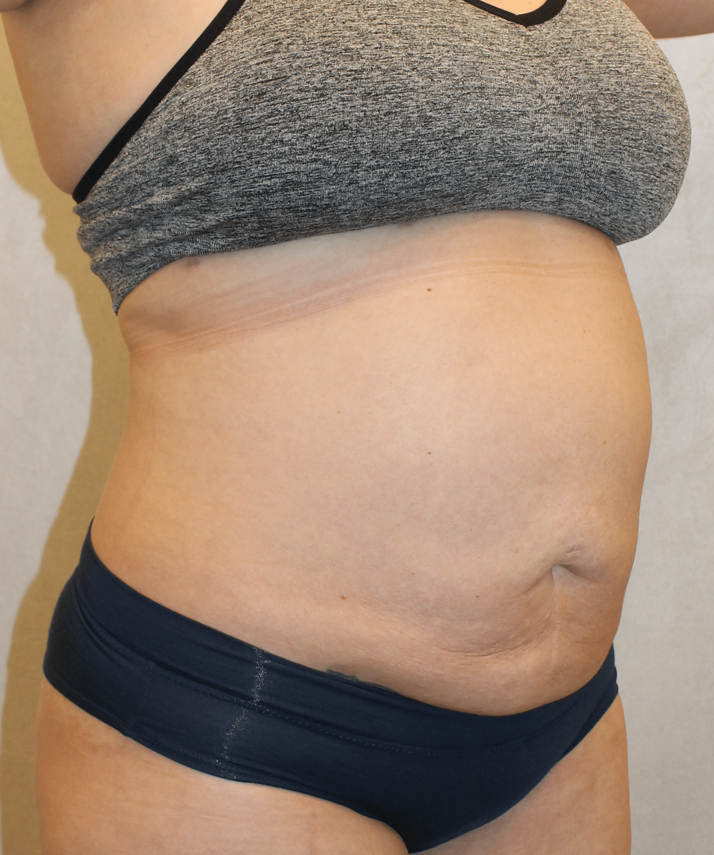 After Image: Case 9689 – Gaines Plastic Surgery - right-front-oblique