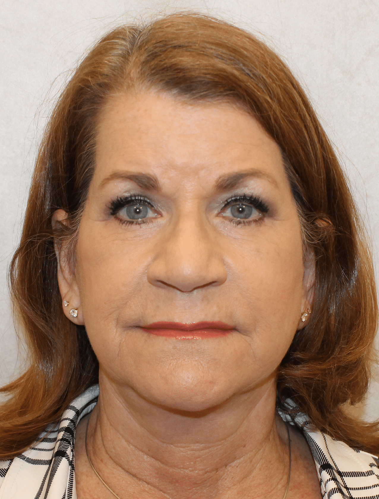After Image: Case 9619 – Gaines Plastic Surgery - front