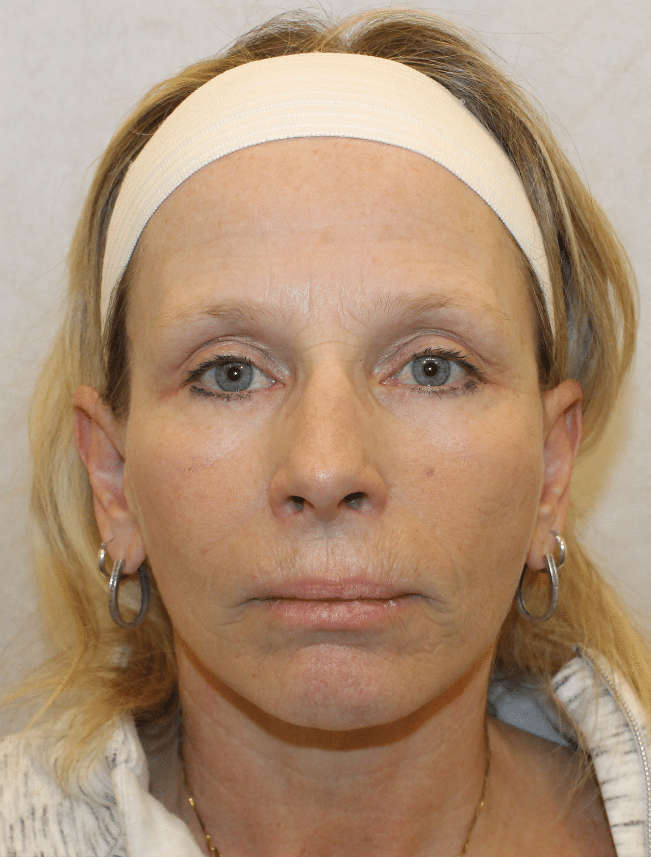 After Image: Case 9678 – Gaines Plastic Surgery - front