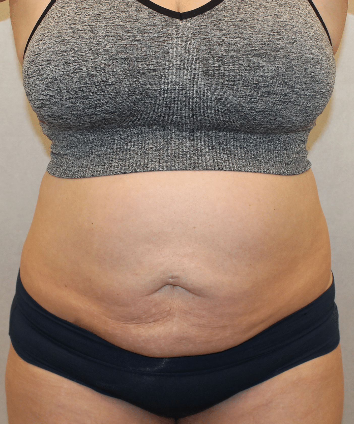 After Image: Case 9689 – Gaines Plastic Surgery - front