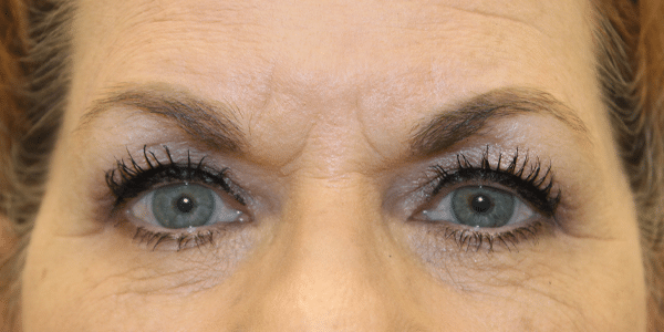 Before Image: Case 9619 – Gaines Plastic Surgery - front