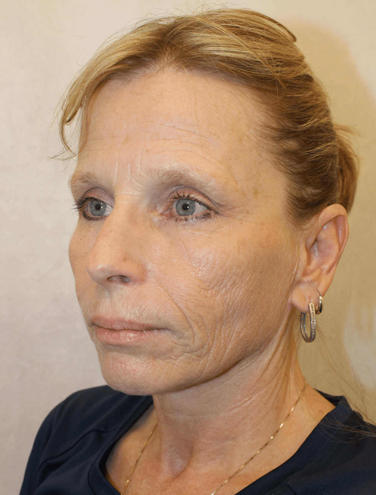 Before Image: Case 9678 – Gaines Plastic Surgery - left-front-oblique