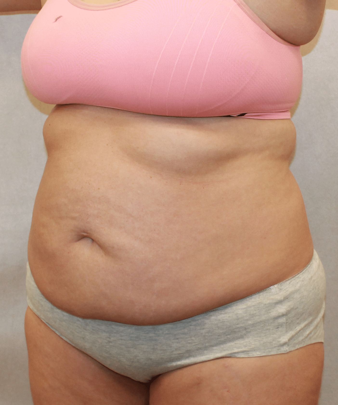 Before Image: Case 9689 – Gaines Plastic Surgery - left-front-oblique