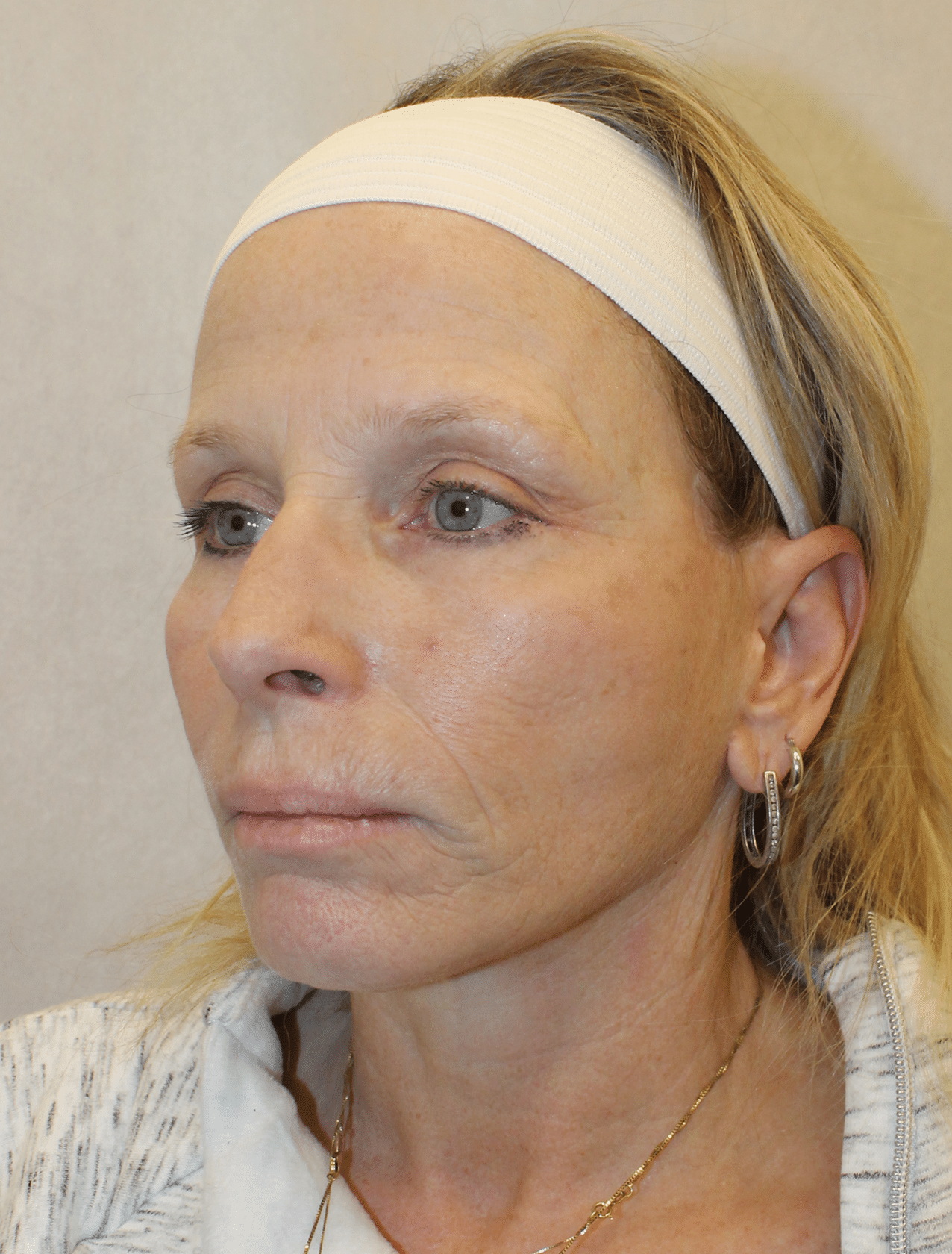 After Image: Case 9678 – Gaines Plastic Surgery - left-front-oblique