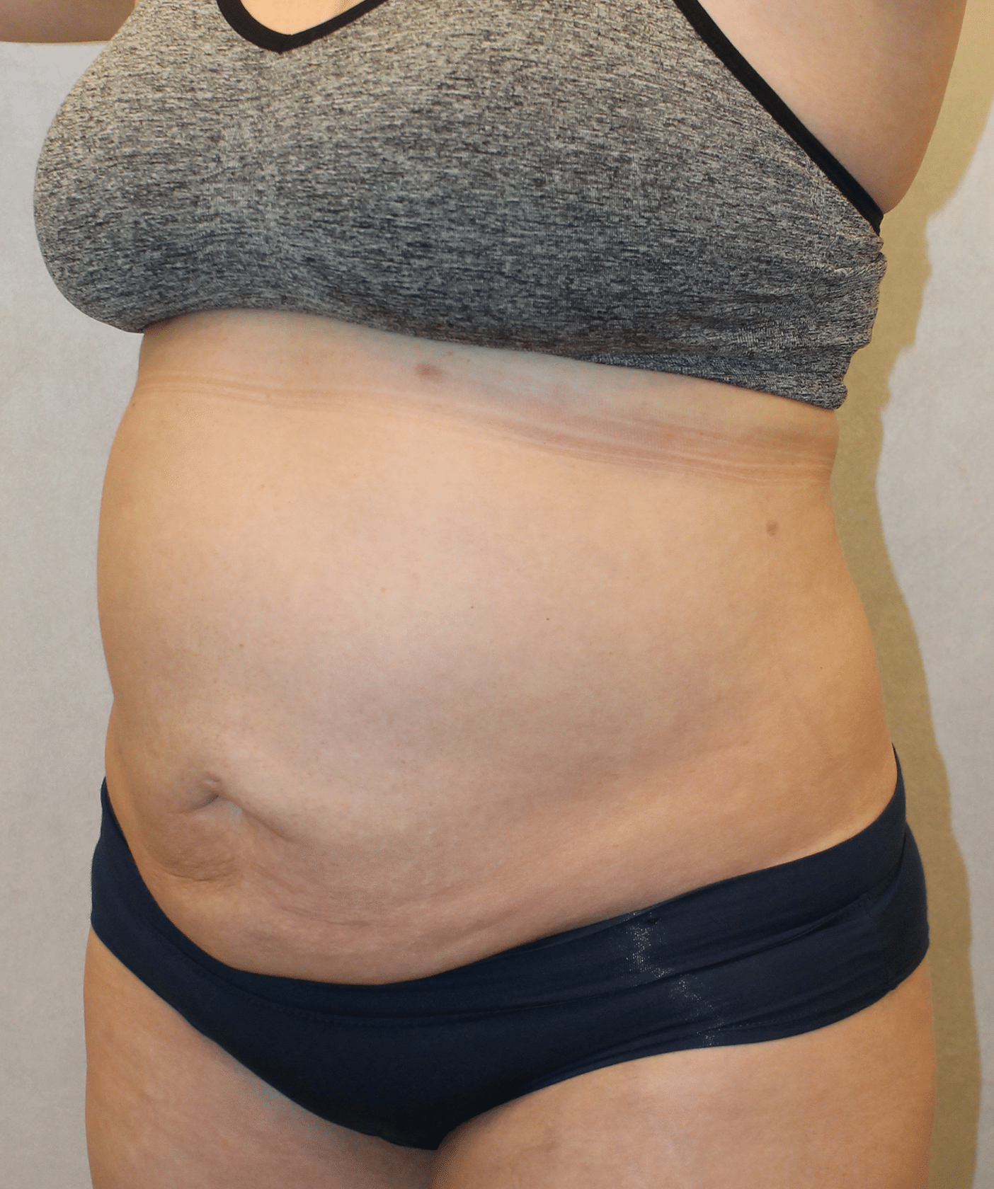 After Image: Case 9689 – Gaines Plastic Surgery - left-front-oblique