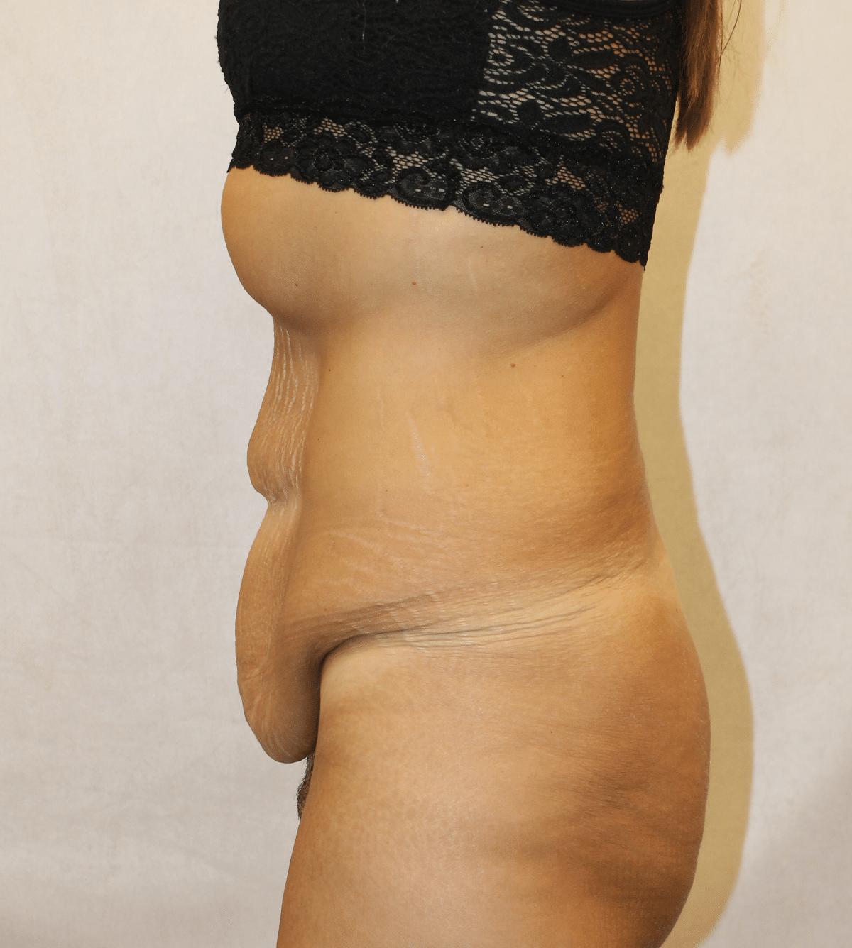 Before Image: Case 9665 – Gaines Plastic Surgery - left-side