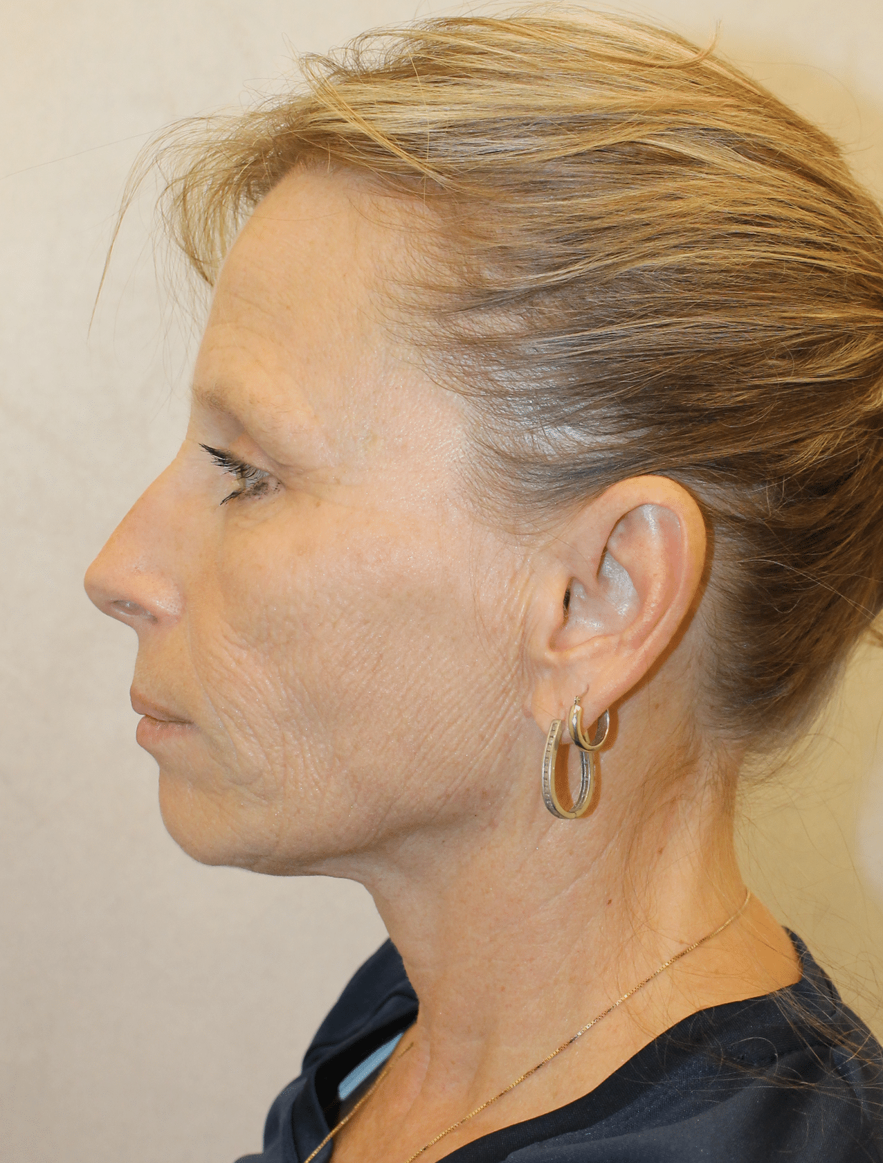Before Image: Case 9678 – Gaines Plastic Surgery - left-side