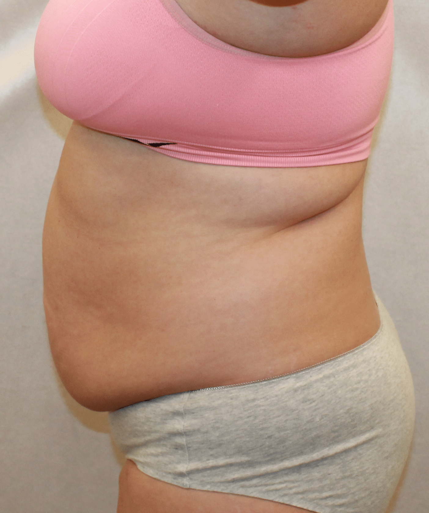 Before Image: Case 9689 – Gaines Plastic Surgery - left-side