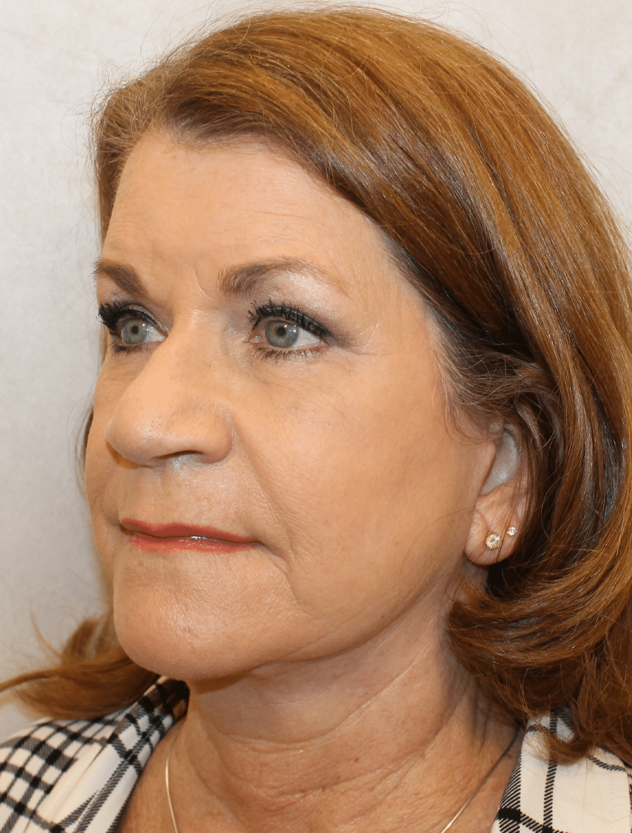 After Image: Case 9619 – Gaines Plastic Surgery - left-front-oblique