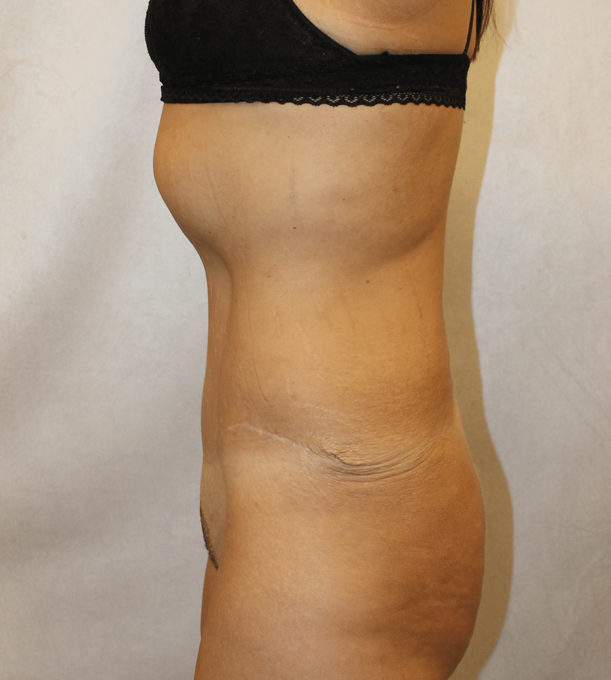 After Image: Case 9665 – Gaines Plastic Surgery - left-side