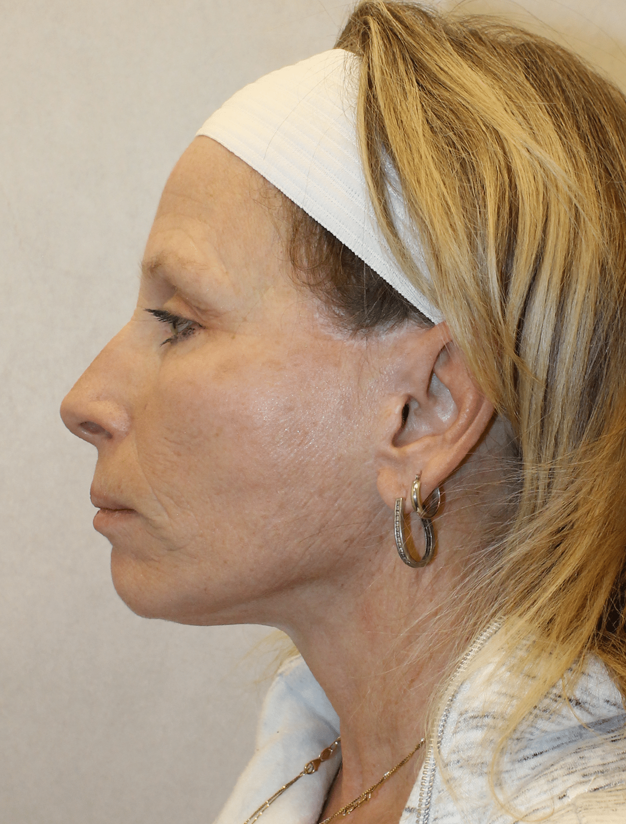 After Image: Case 9678 – Gaines Plastic Surgery - left-side