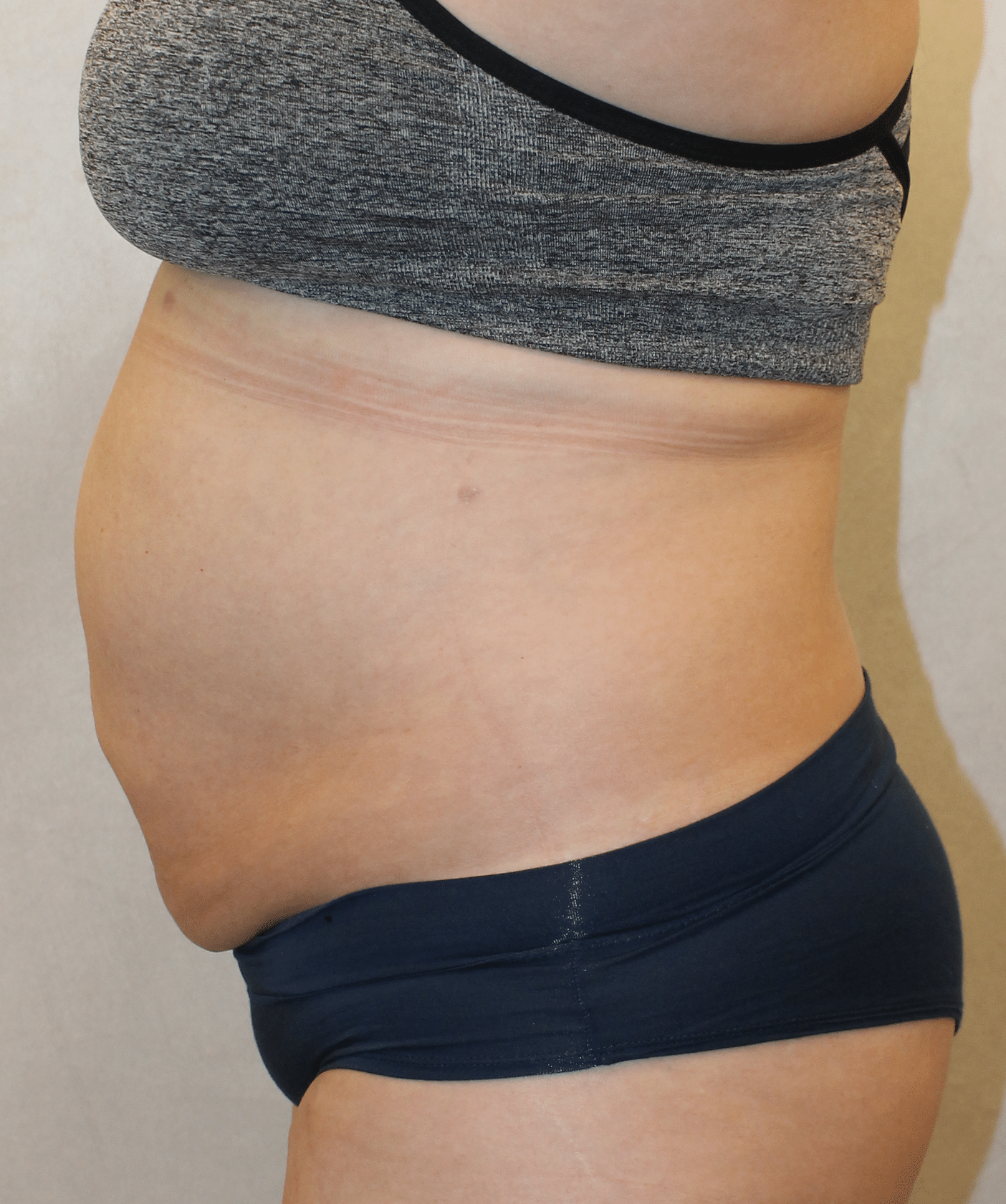 After Image: Case 9689 – Gaines Plastic Surgery - left-side