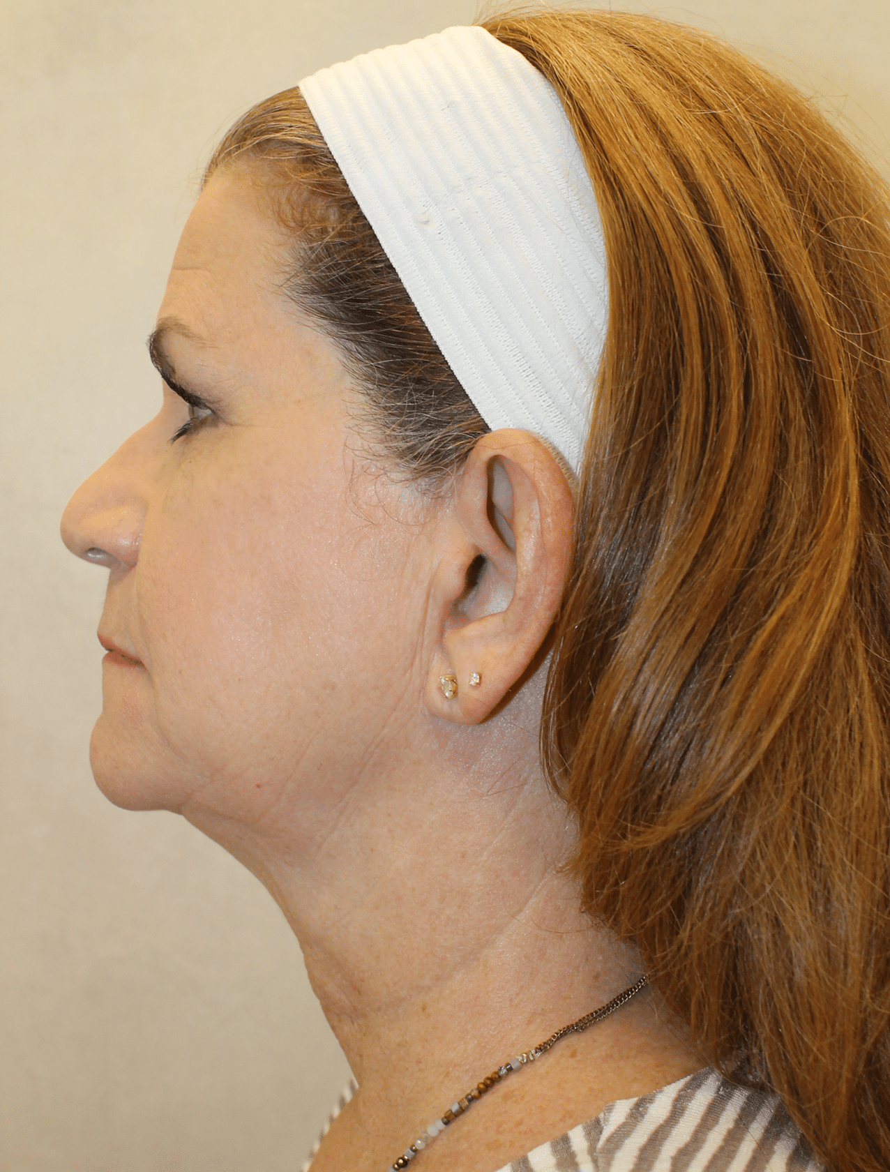 Before Image: Case 9619 – Gaines Plastic Surgery - left-side