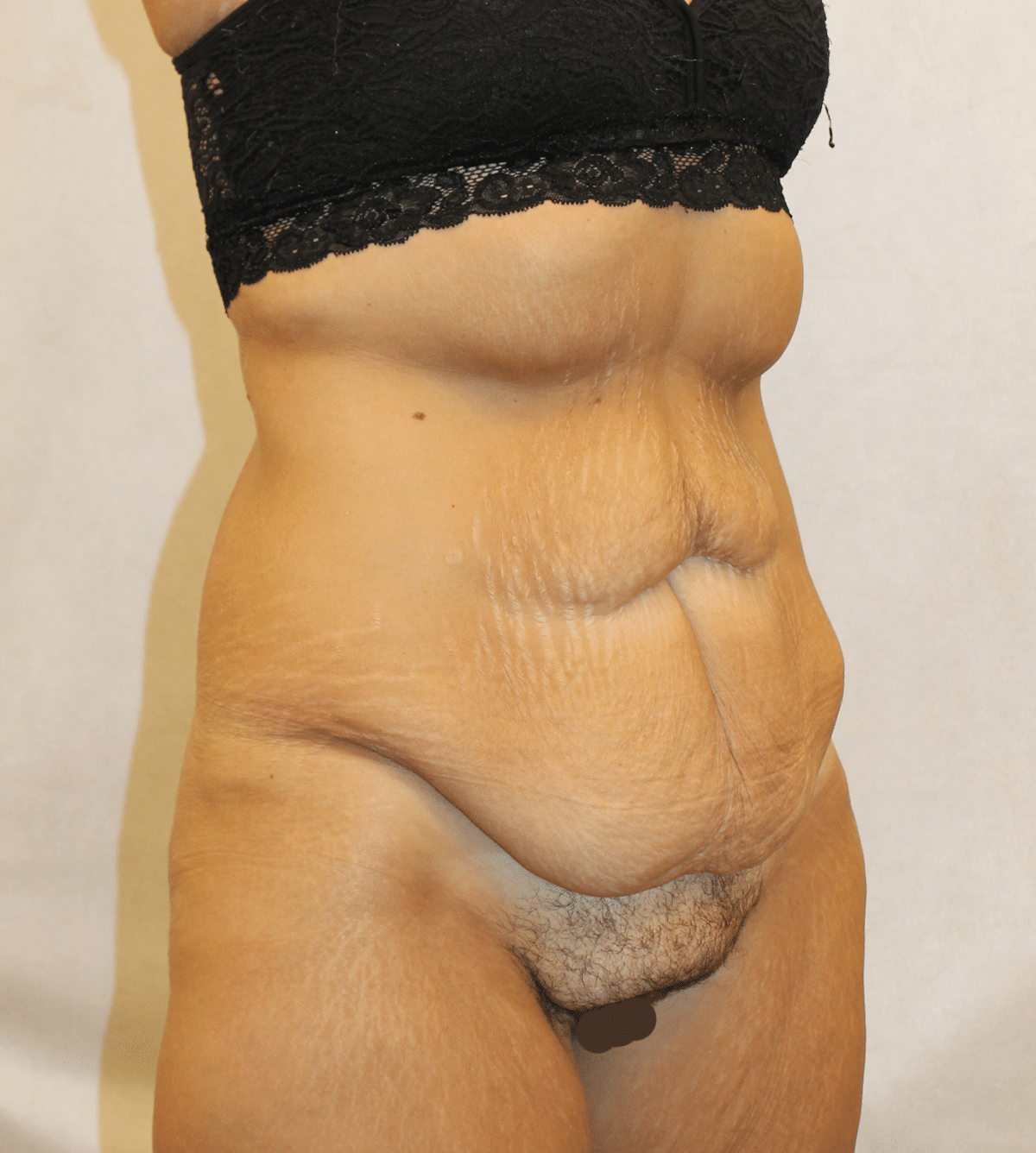 Before Image: Case 9665 – Gaines Plastic Surgery - right-front-oblique