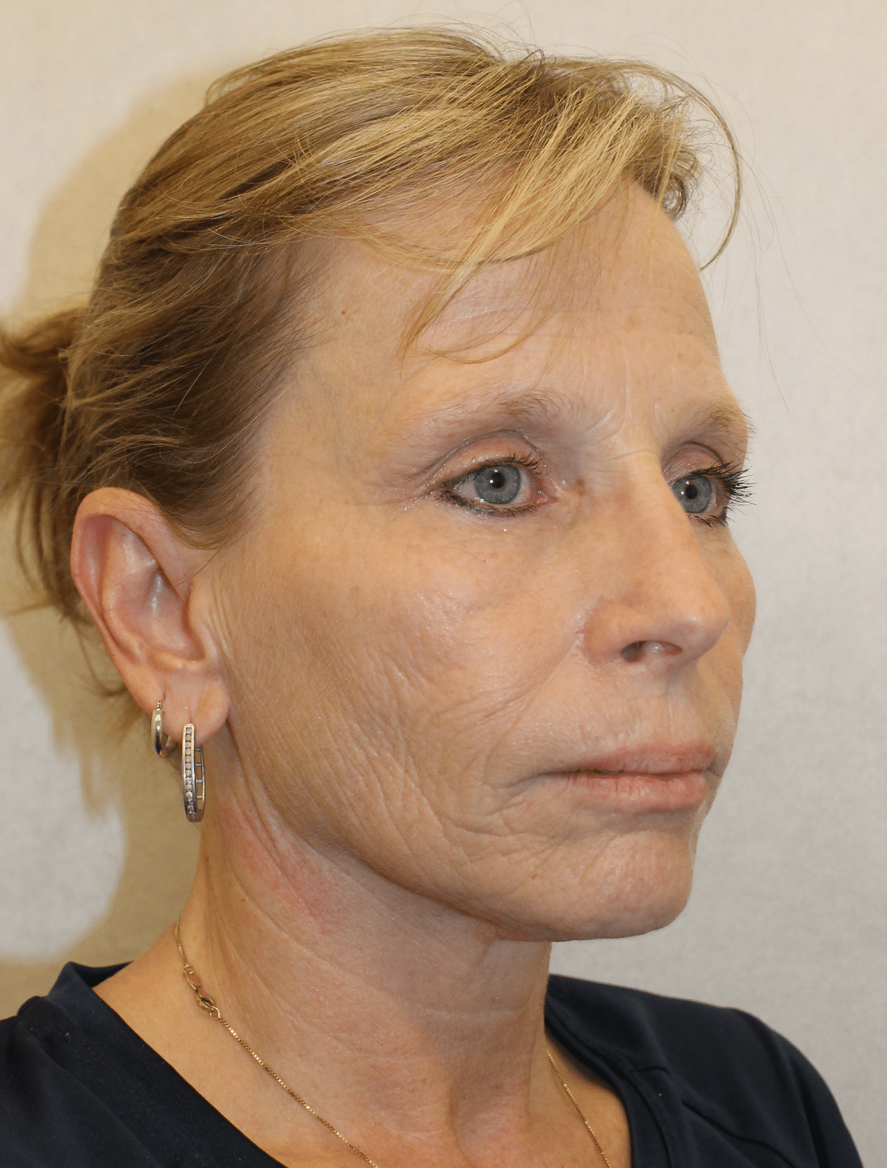 Before Image: Case 9678 – Gaines Plastic Surgery - right-front-oblique