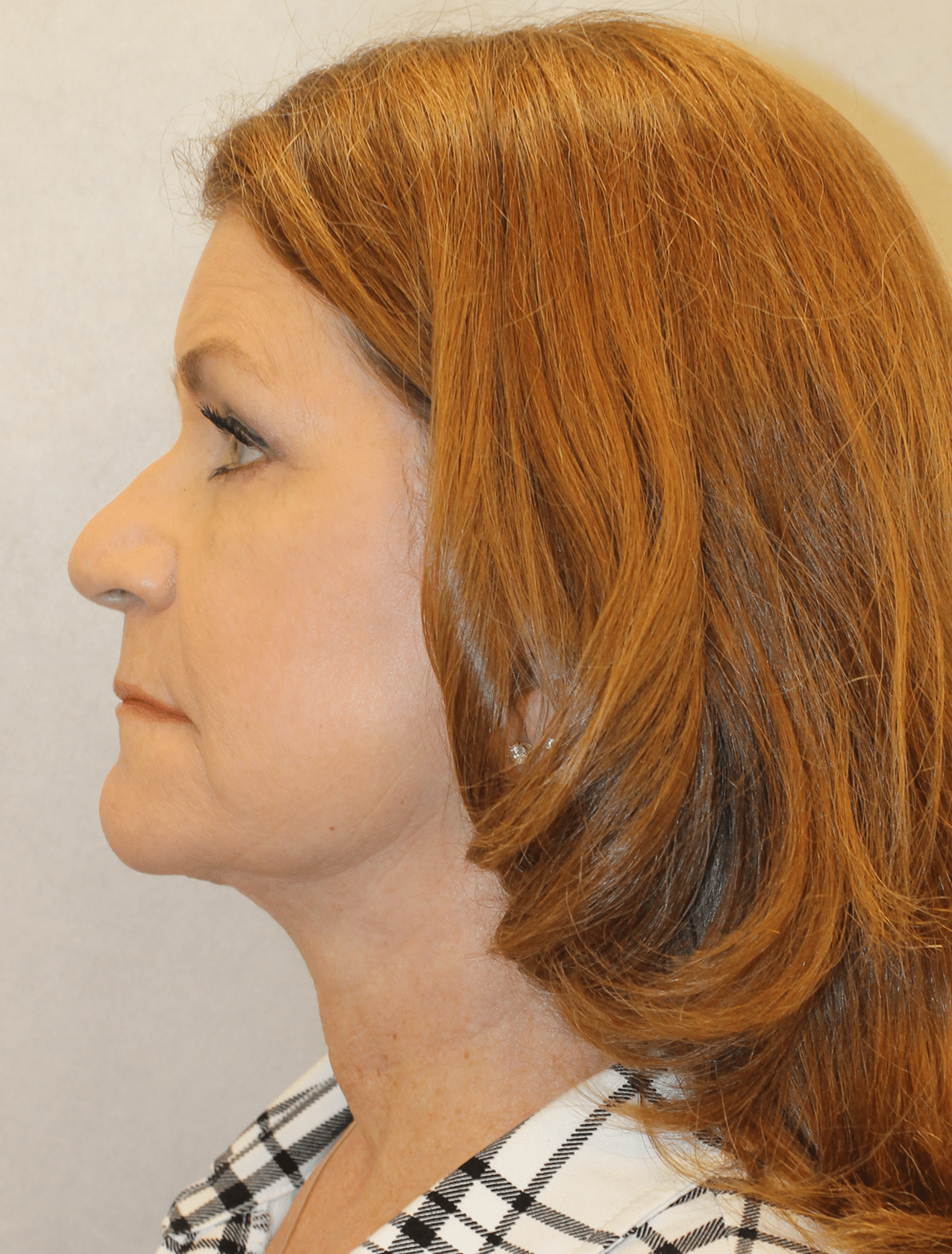 After Image: Case 9619 – Gaines Plastic Surgery - left-side
