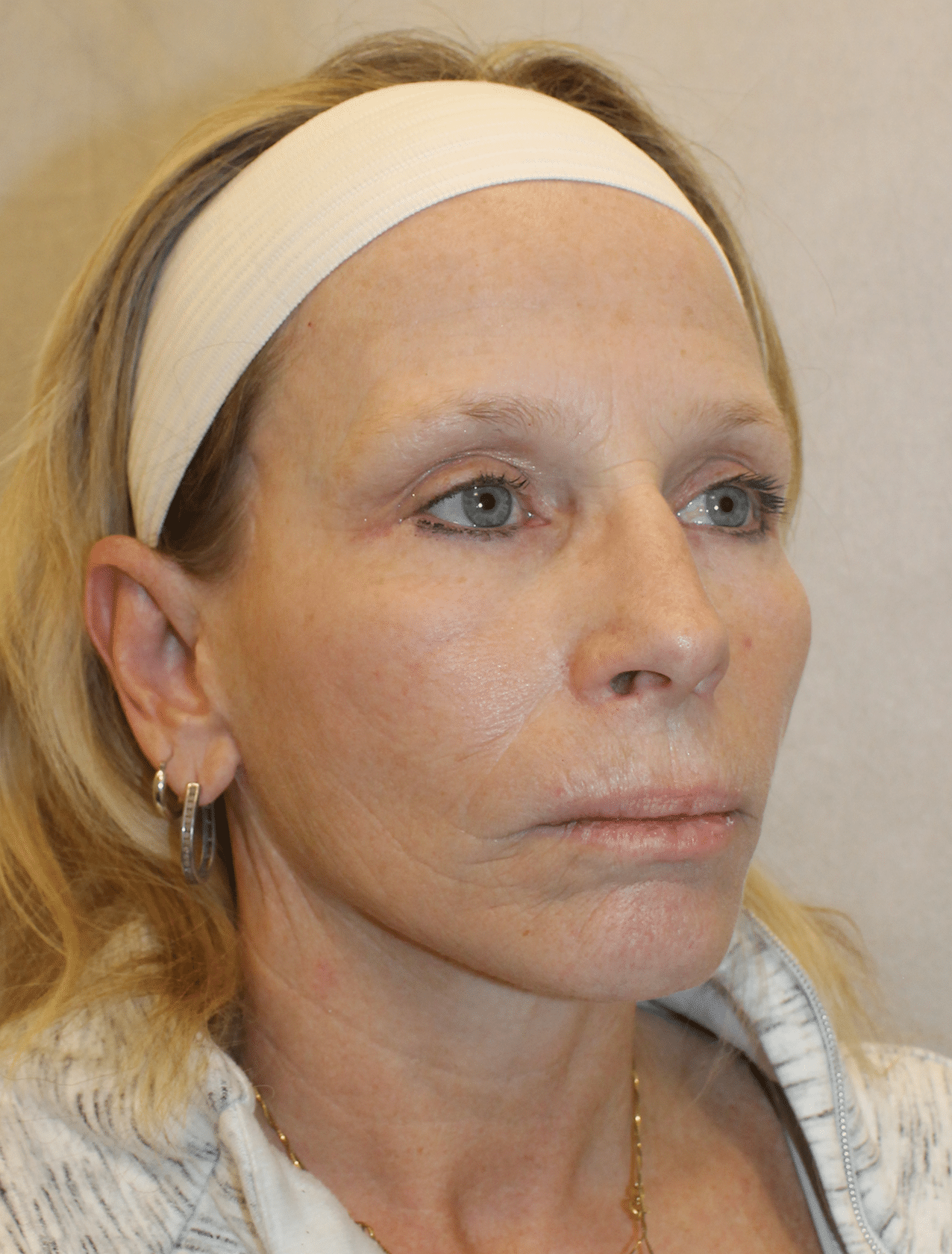 After Image: Case 9678 – Gaines Plastic Surgery - right-front-oblique
