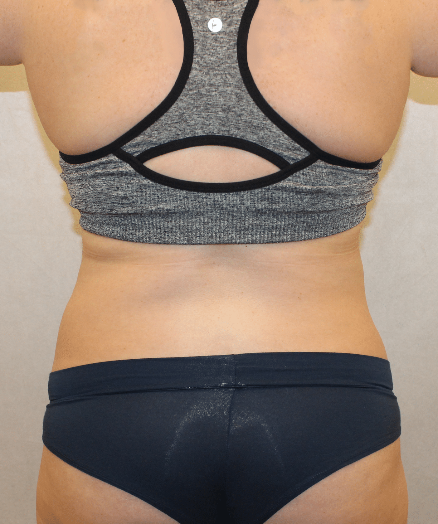 After Image: Case 9689 – Gaines Plastic Surgery - back