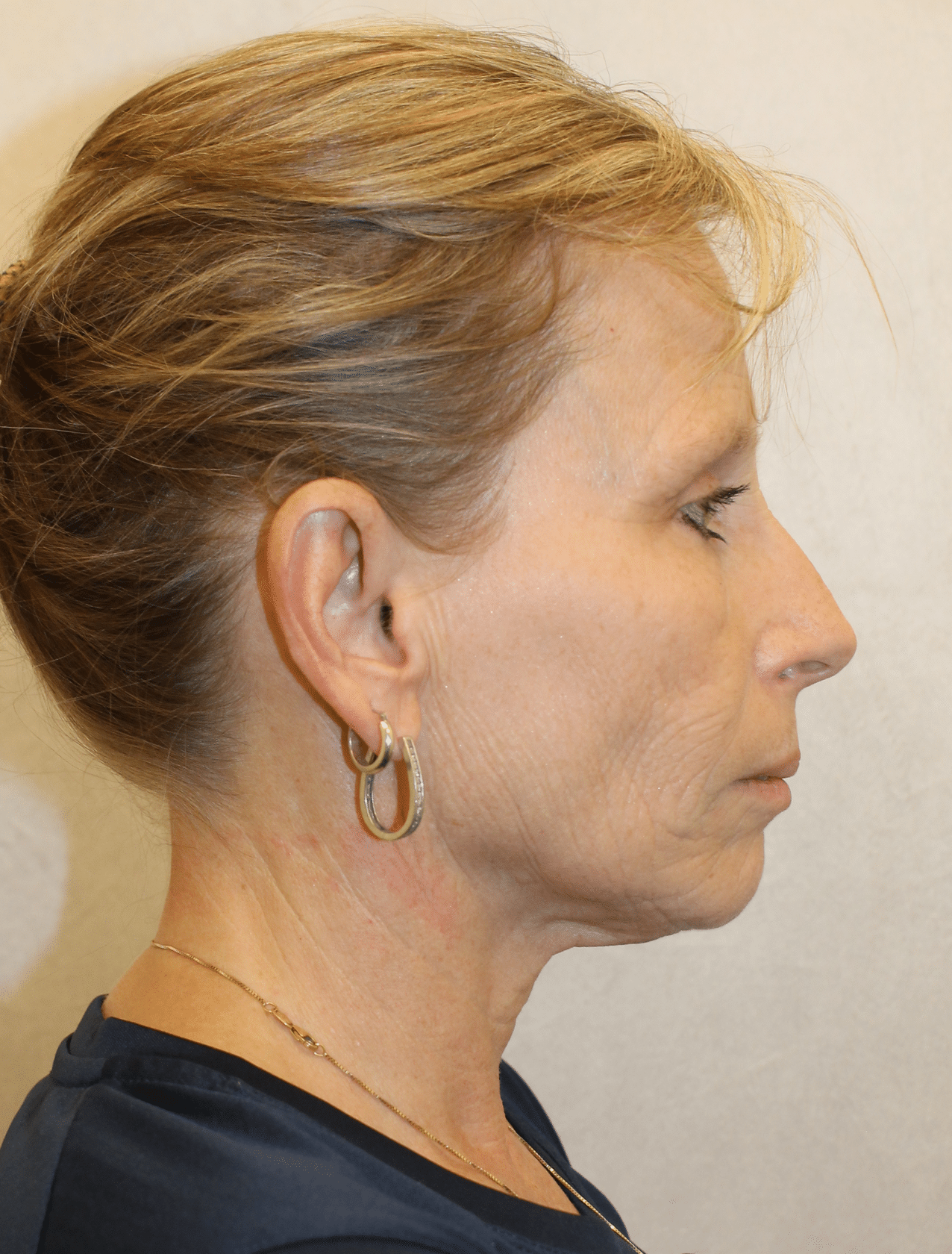 Before Image: Case 9678 – Gaines Plastic Surgery - right-side