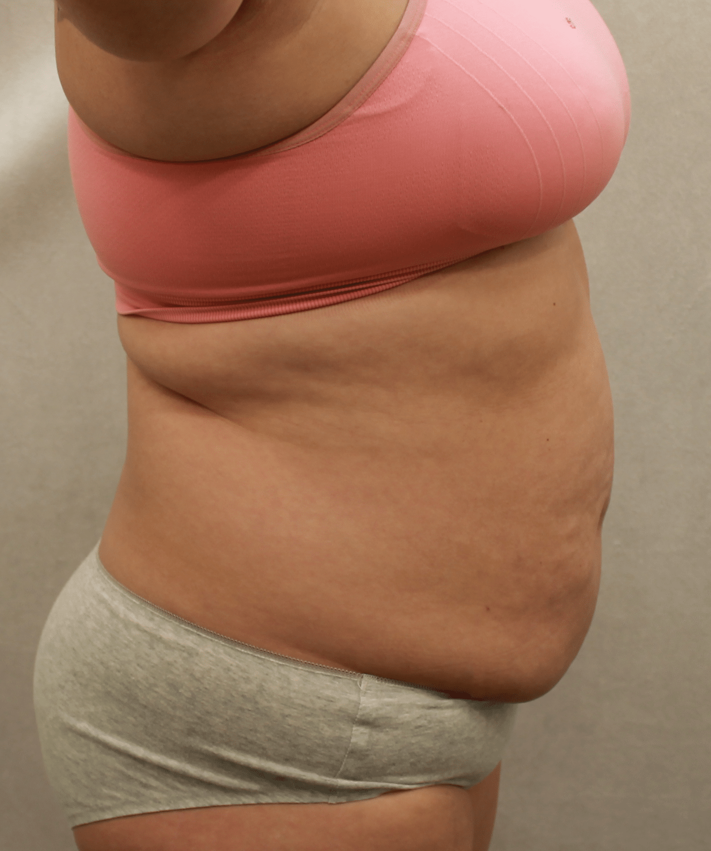 Before Image: Case 9689 – Gaines Plastic Surgery - right-side