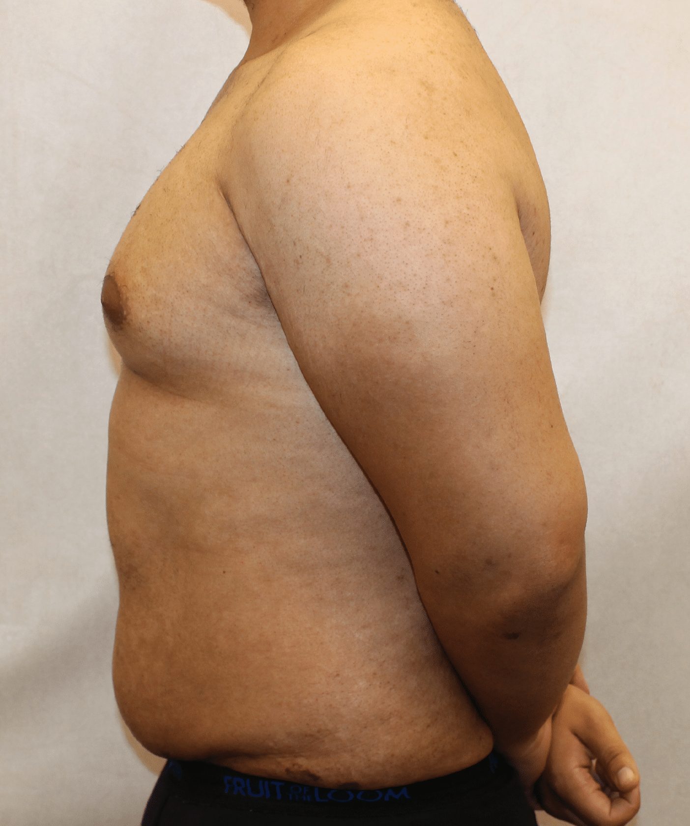 Before Image: Case 9767 – Gaines Plastic Surgery - left-side