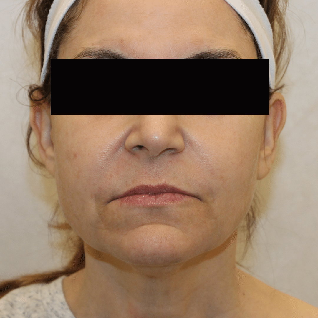 Before Image:  - front