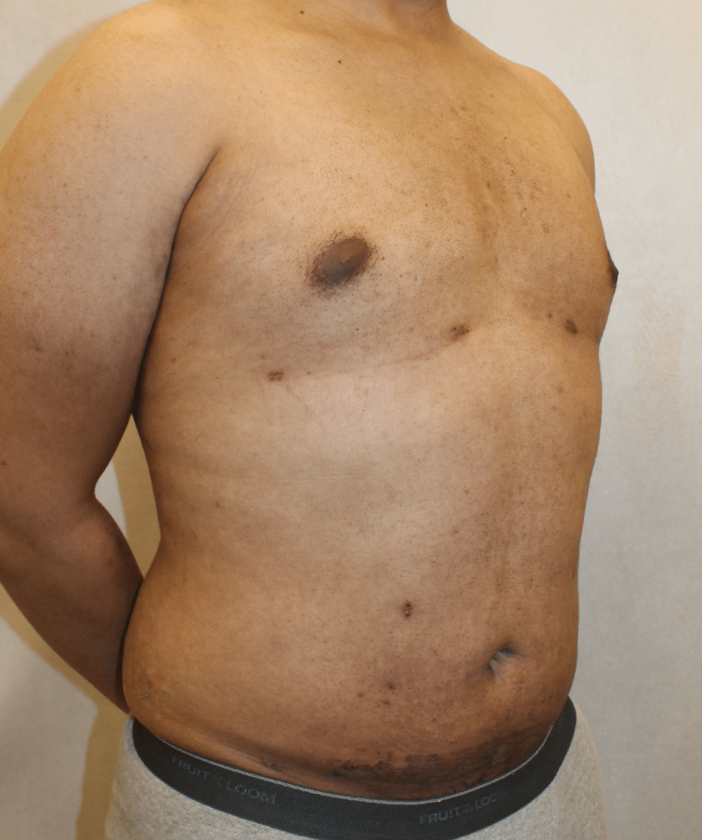 After Image: Case 9767 – Gaines Plastic Surgery - right-front-oblique
