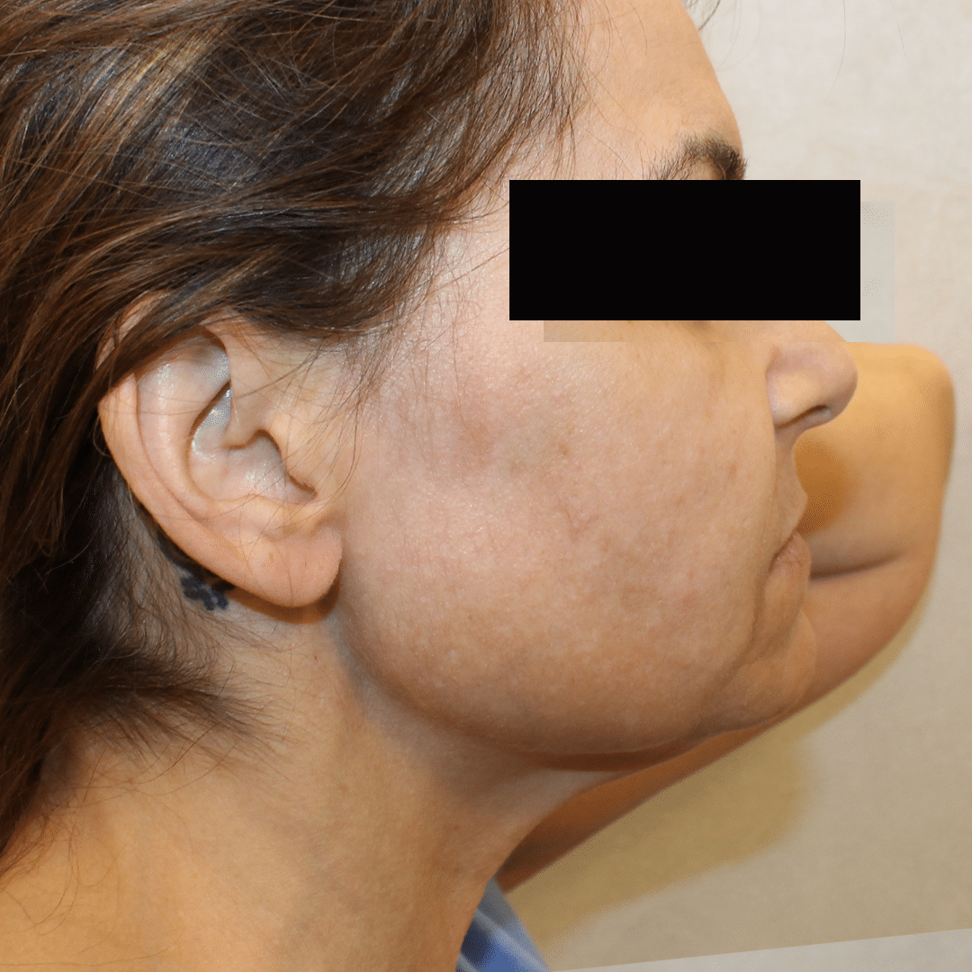 After Image:  - right-side