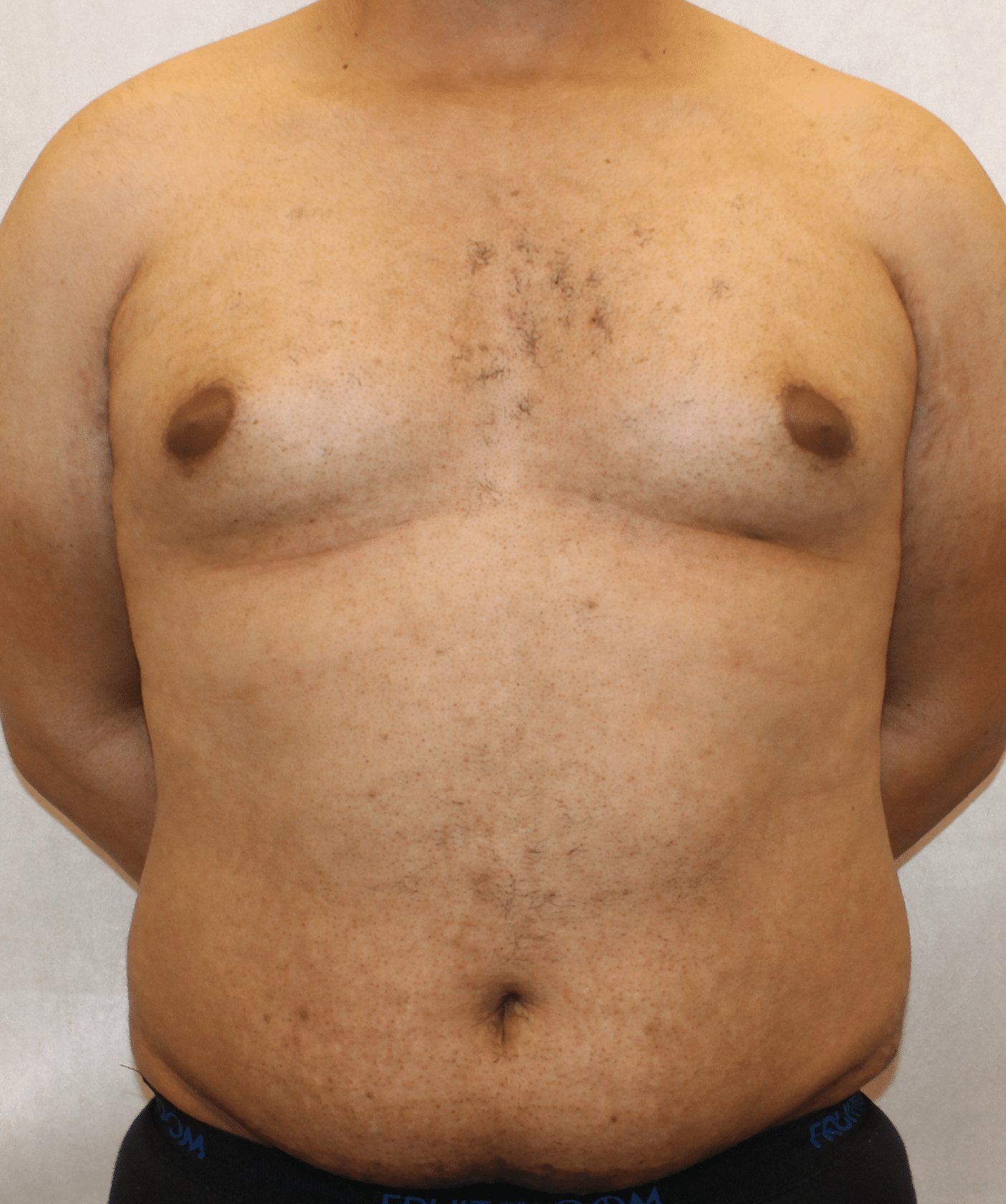 Before Image: Case 9767 – Gaines Plastic Surgery - front