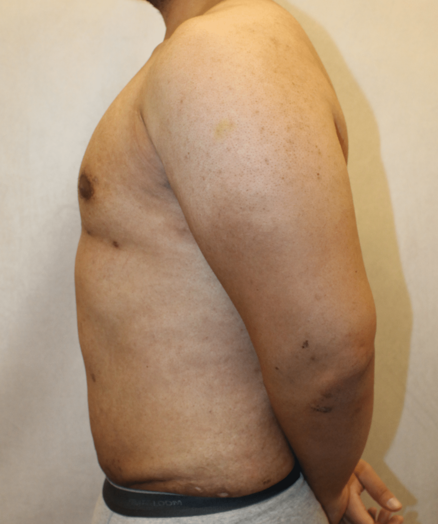 After Image: Case 9767 – Gaines Plastic Surgery - left-side