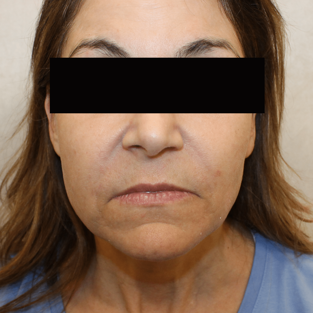 After Image:  - front