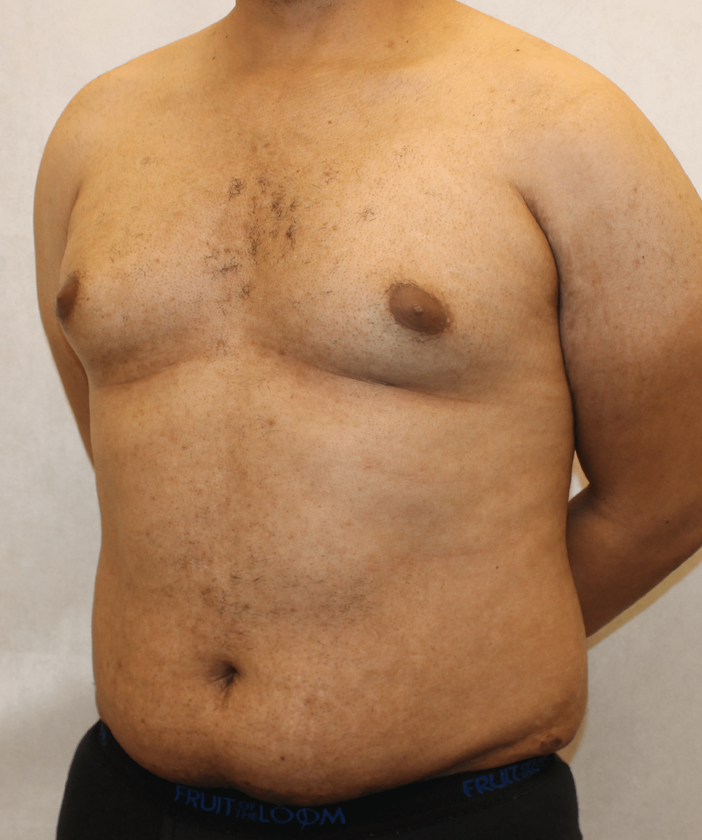 Before Image: Case 9767 – Gaines Plastic Surgery - left-front-oblique