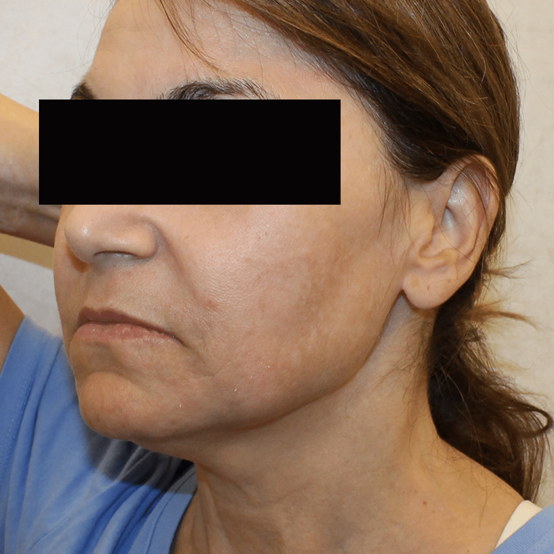 After Image:  - left-front-oblique