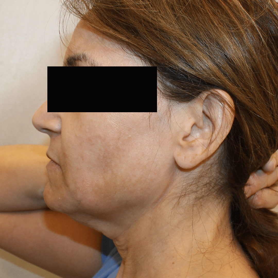 After Image:  - left-side