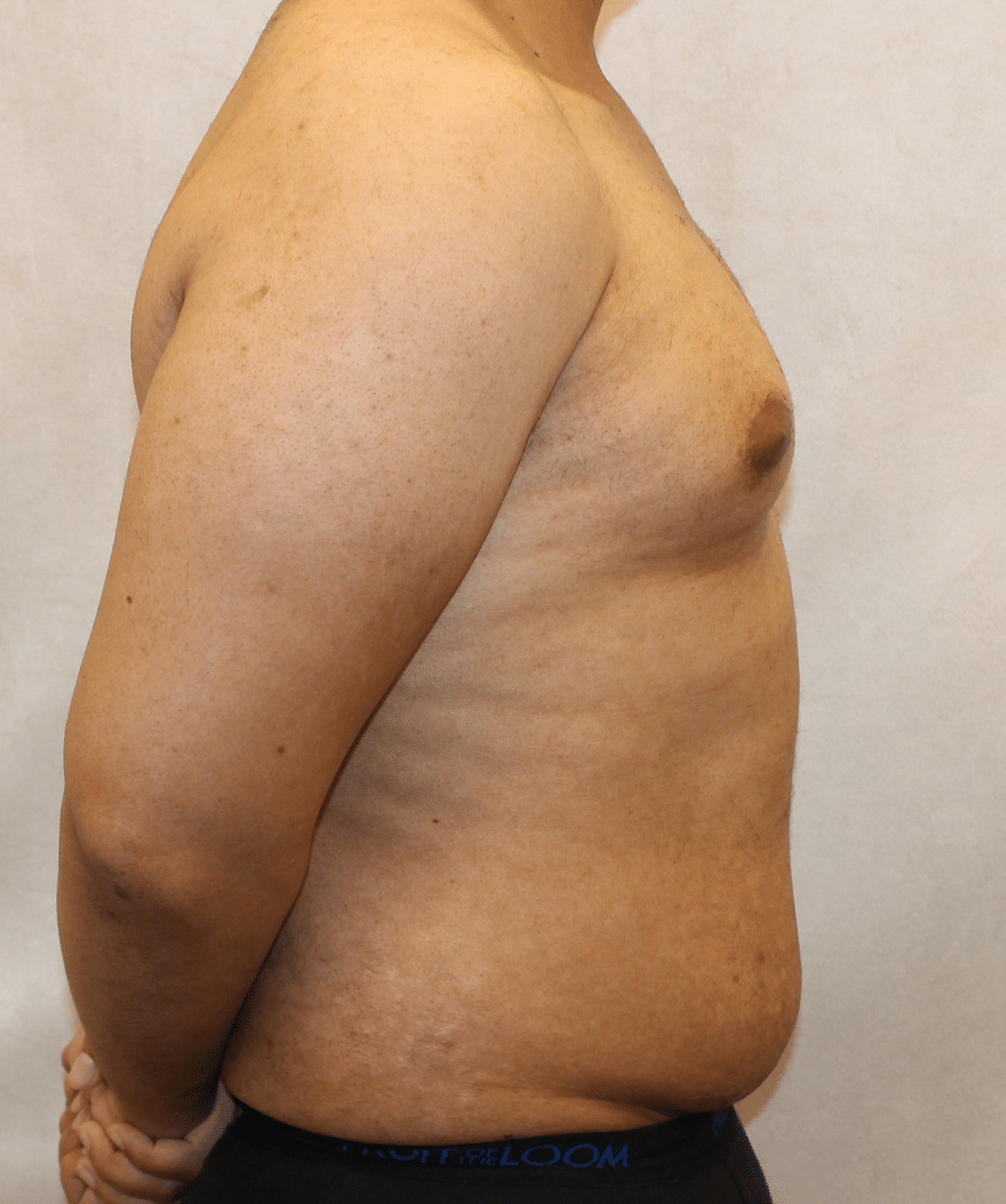 Before Image: Case 9767 – Gaines Plastic Surgery - right-side