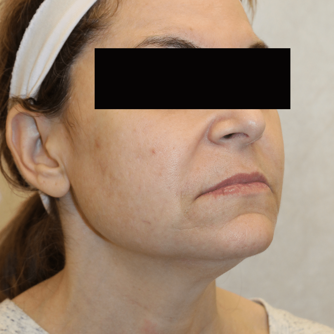 Before Image:  - right-front-oblique
