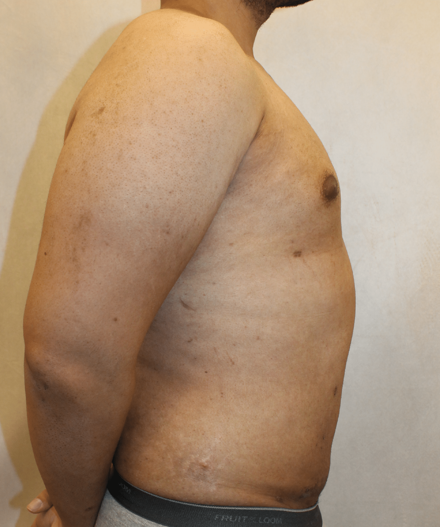 After Image: Case 9767 – Gaines Plastic Surgery - right-side