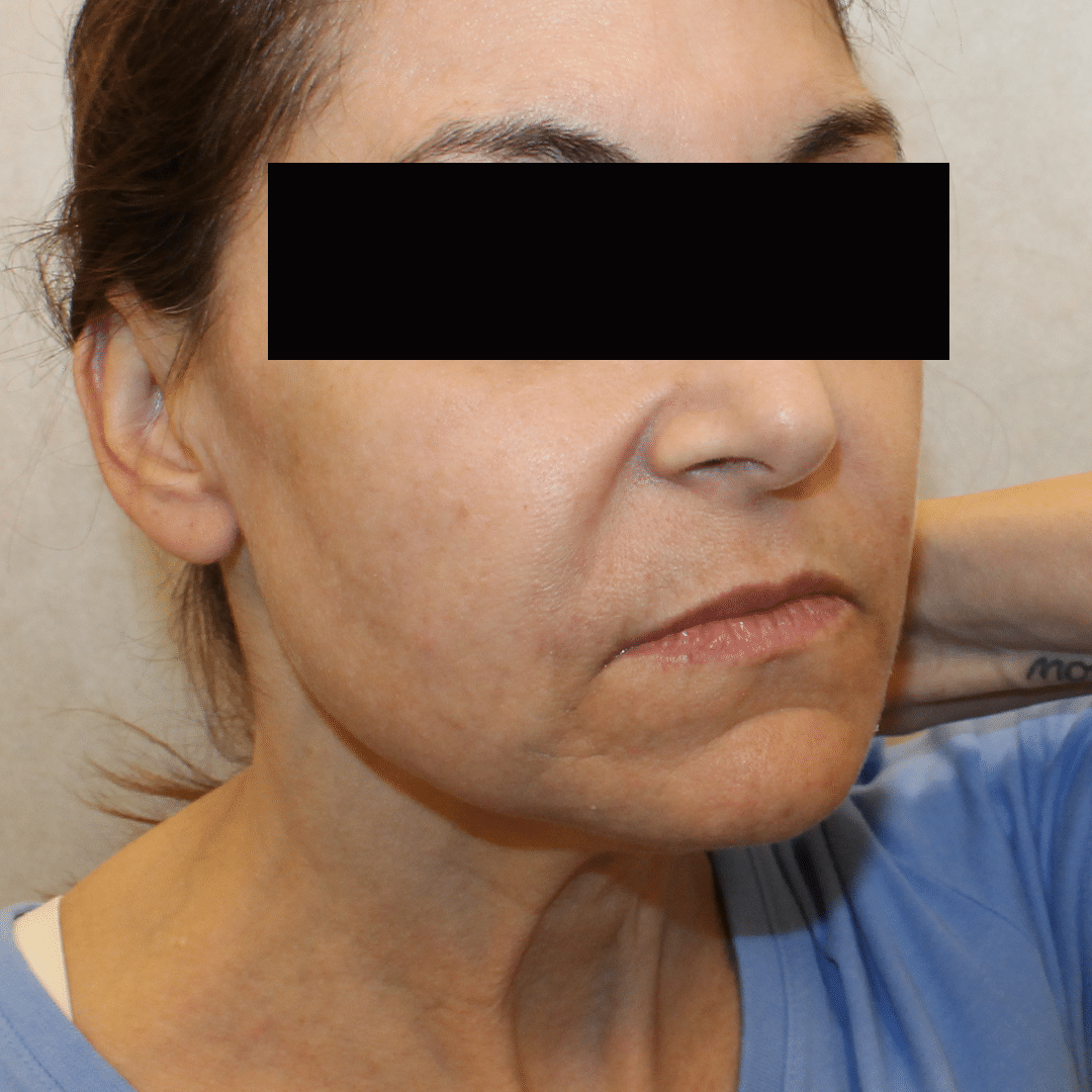 After Image:  - right-front-oblique