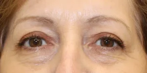 Brow Lift