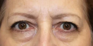 Brow Lift