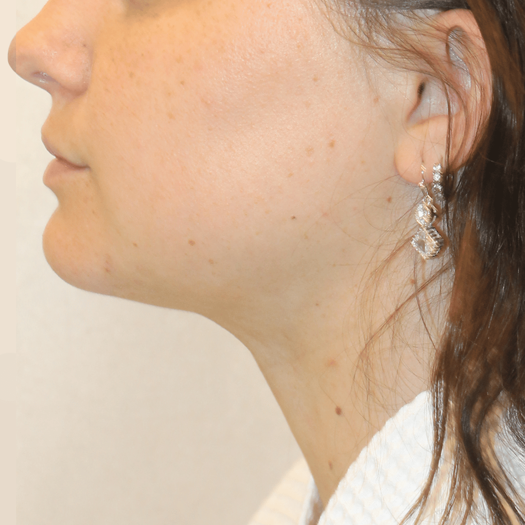 After Image:  - left-side