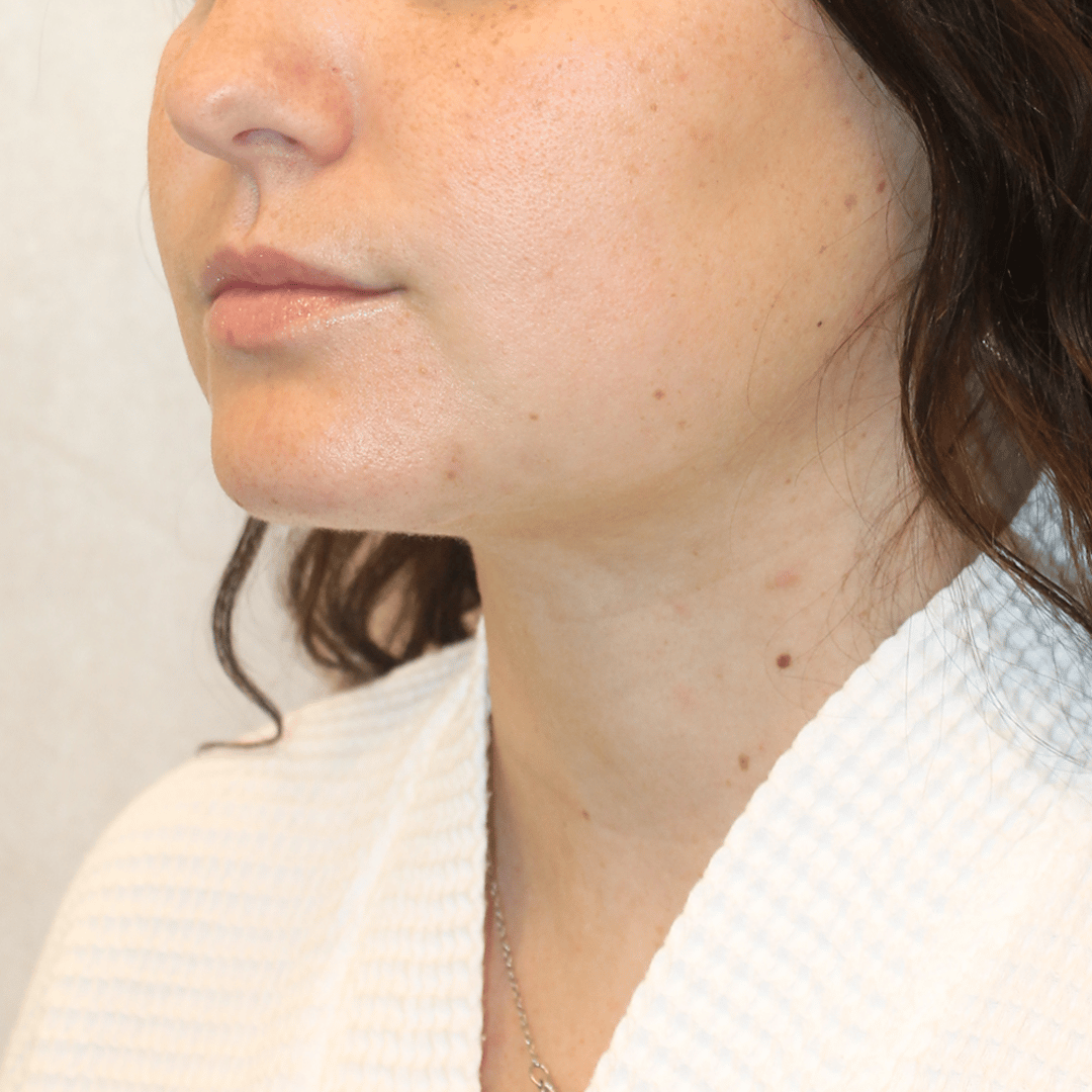 After Image:  - left-front-oblique