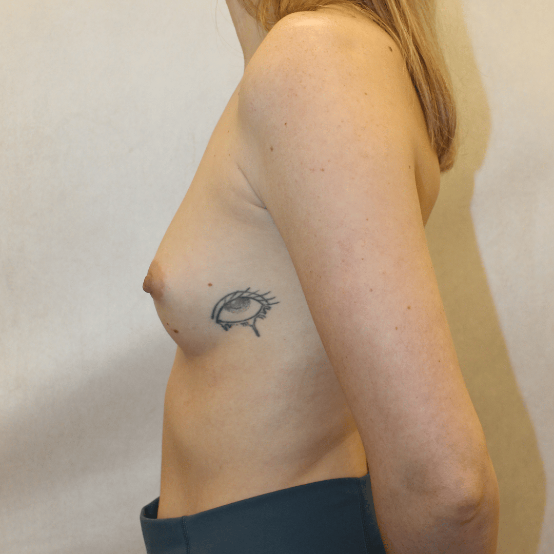 Before Image:  - left-side