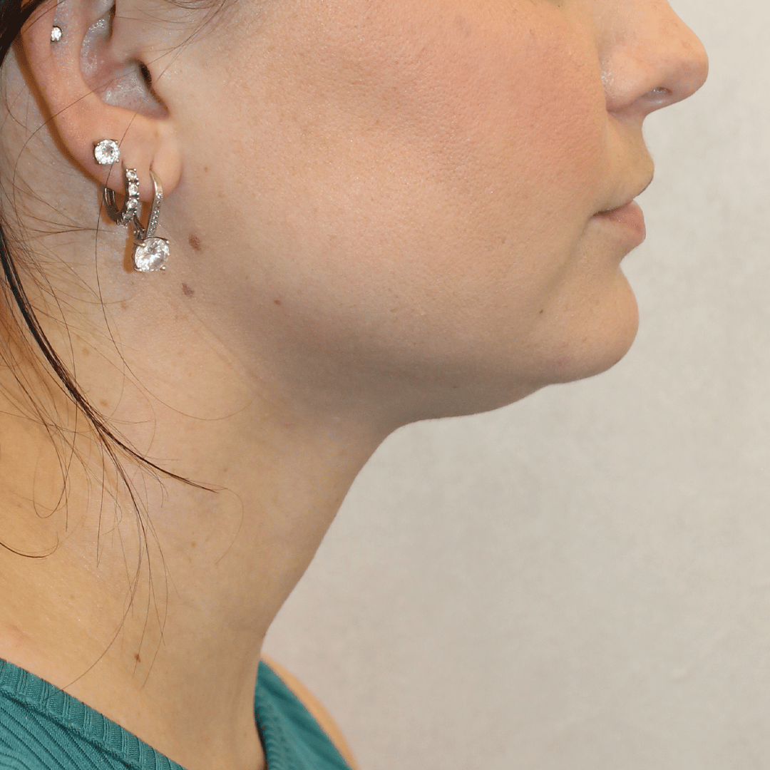 Before Image:  - right-side